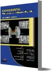 Leer «Caries Dental. Principios y Procedimientos para el Diagnostico» online PDF Gilberto Henostroza 2022 + eBook