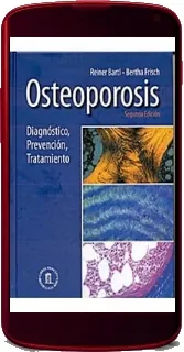 Descargar libro + resumen Osteoporosis. Diagnostico, Prevencion, Tratamiento