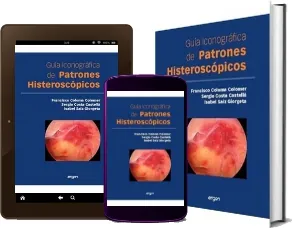 [PDF] » Guia Iconografica de Patrones Histeroscopicos » Isabel Saiz Giorgeta + resumen