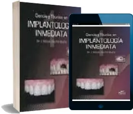 Descargar «Implantologia Inmediata» (COMPLETO) en PDF - ePub - eBook Google Drive
