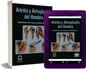 Drive Artritis y Artroplastia Del Hombro PDF en Español